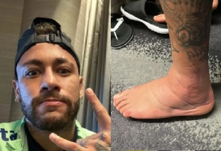 Neymar mostra seu tornozelo lesionado (Foto: Stories do Instagram)