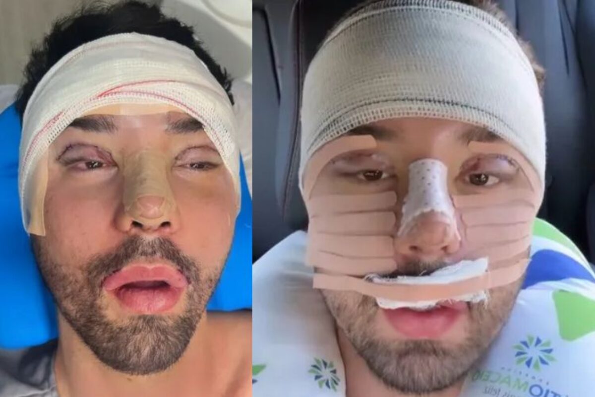 Antes e depois de Rico Melquiades: influenciador revela novo rosto